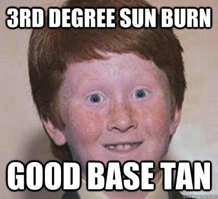 3rd degree sun burn Good base tan  Over Confident Ginger