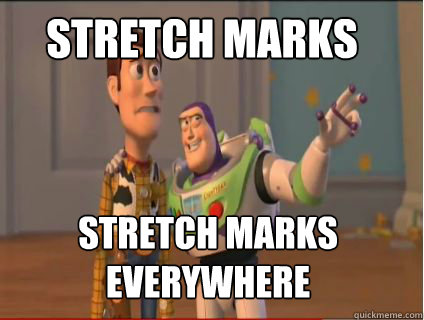 Stretch Marks Stretch Marks everywhere  woody and buzz