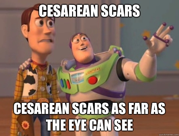 cesarean scars cesarean scars as far as the eye can see  Buzz Lightyear