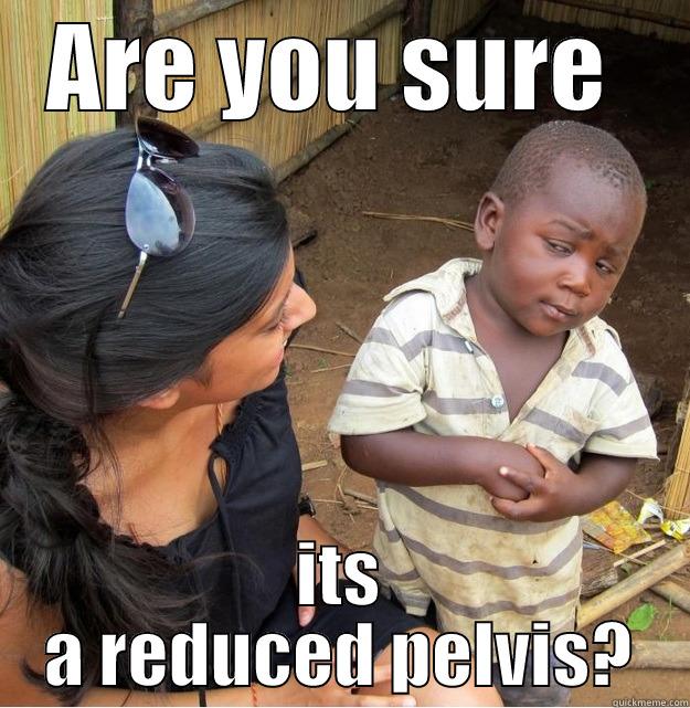 ARE YOU SURE  ITS A REDUCED PELVIS? Skeptical Third World Kid