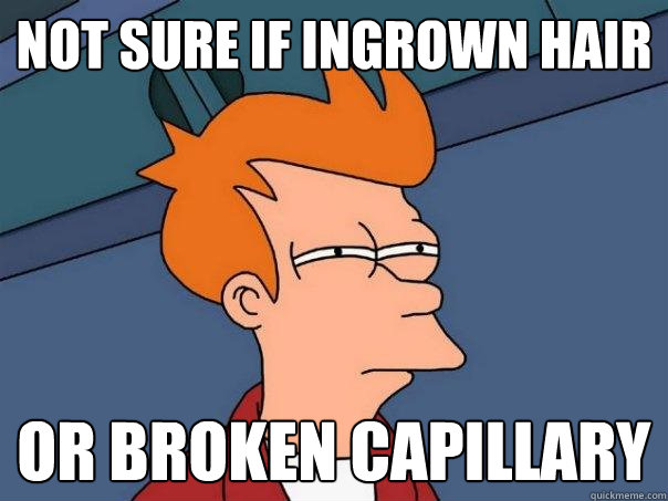 Not sure if ingrown hair Or broken capillary  Futurama Fry