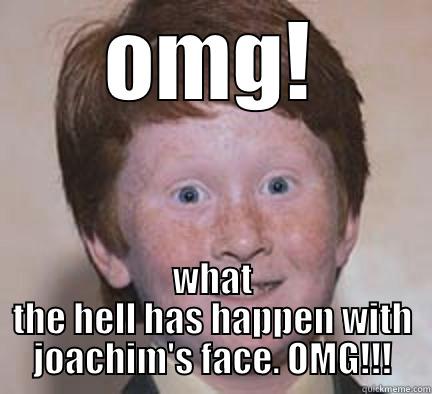 OMG! WHAT THE HELL HAS HAPPEN WITH JOACHIM'S FACE. OMG!!! Over Confident Ginger