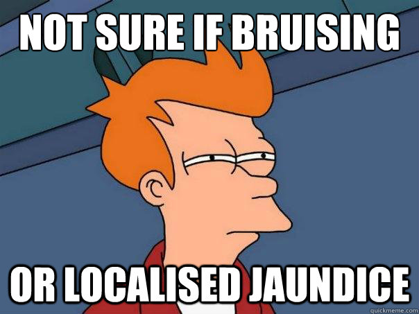 Not sure if bruising or localised jaundice - Not sure if bruising or localised jaundice  Futurama Fry