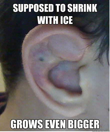 Supposed to shrink with ice Grows Even Bigger - Supposed to shrink with ice Grows Even Bigger  Scumbag Cauliflower ear