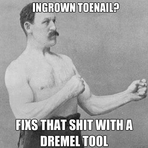 Ingrown Toenail? Fixs that shit with a Dremel tool - Ingrown Toenail? Fixs that shit with a Dremel tool  Misc