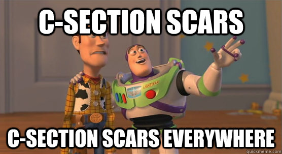 c-section scars c-section scars everywhere  