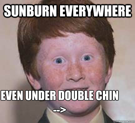 Sunburn everywhere even under double chin 
-->  Over Confident Ginger